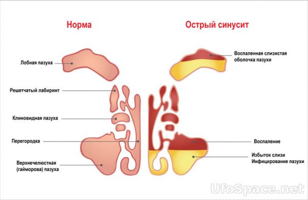 Пять природных средств для защиты от синусита